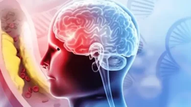 Signifikans Penanganan Stroke Cepat, Jangan Lewati Golden Periode agar Pulih Lebih Baik