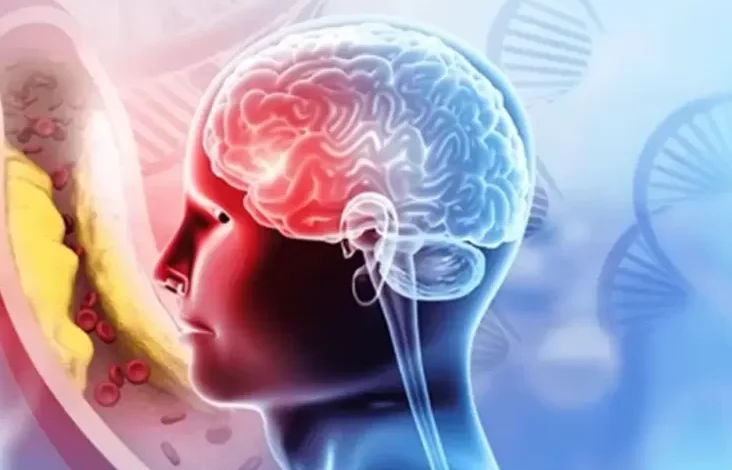 Signifikans Penanganan Stroke Cepat, Jangan Lewati Golden Periode agar Pulih Lebih Baik