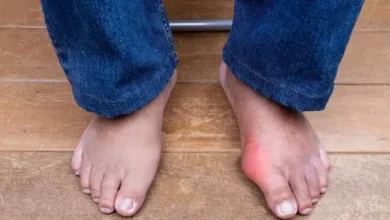 Penyebab Asam Urat di Usia Muda, 5 Kebiasaan Tidak Baik Hal ini Harus Dihindari